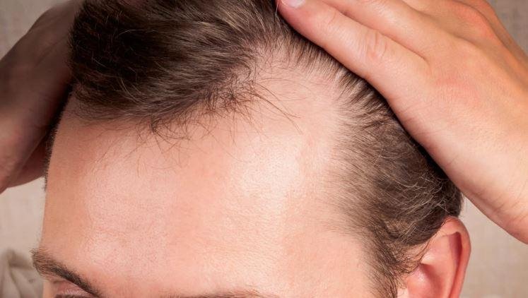 الصلع الوراثي.. لماذا قد يبدأ في سن مبكرة ومن الأكثر عرضة؟