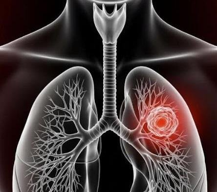 الفطريات قد تكون السبب.. متى يشك الطبيب في الالتهاب الرئوي الفطري؟