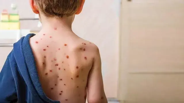 هل يمكن الإصابة بجدري الماء أكثر من مرة؟