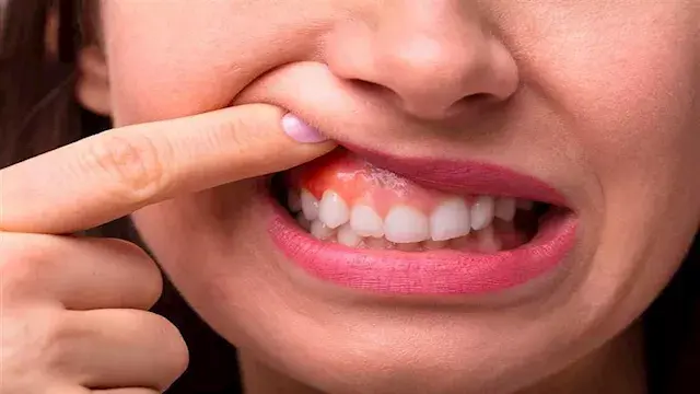علامة في اللثة قد تكشف خطرا صامتا على القلب