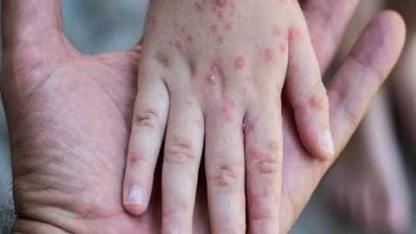 الأمم المتحدة تحذر من انتشار واسع وسريع لمرض جدري الماء في غزة