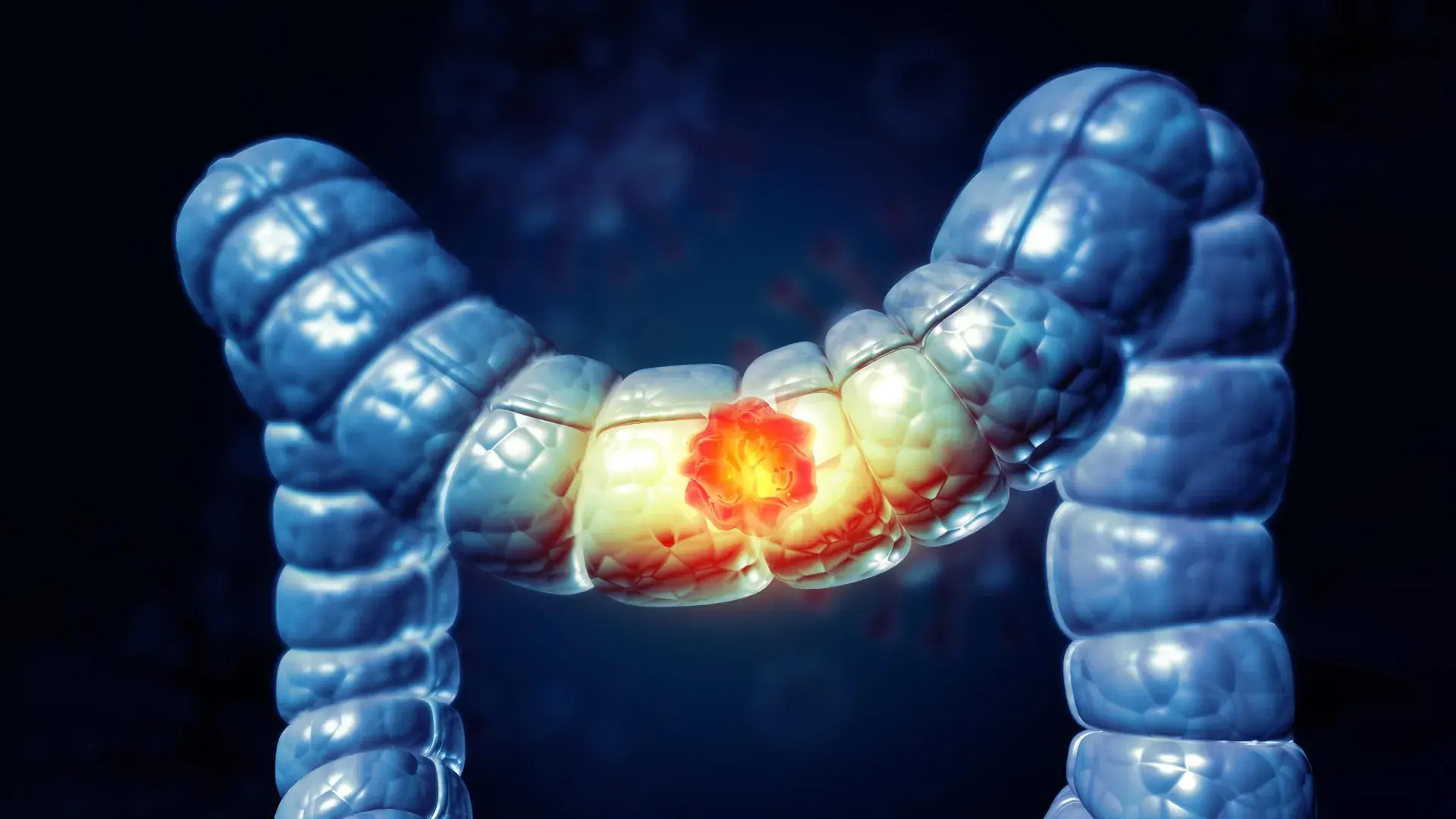 A simple at-home test could cut colorectal cancer death risk by 43%