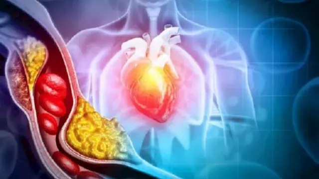 ماذا يحدث لشرايينك عندما يرتفع الكوليسترول دون أعراض؟