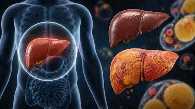 5 أطعمة ومشروبات قد تساعد على تقليل الكبد الدهني