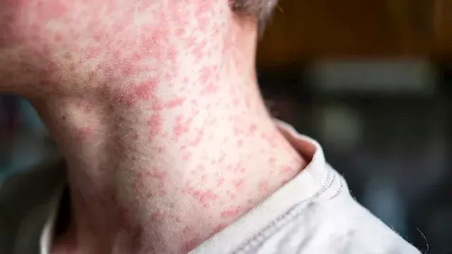 إصابات الحصبة في أمريكا تسجل أعلى مستوى منذ 35 عاما
