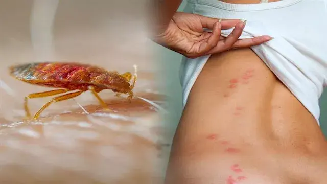 6 علامات تكشف وجود بق الفراش في منزلك.. لدغات تظهر بعد النوم
