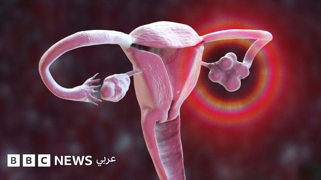 ليست مجرد مشكلة في المبيض: ما الذي يجب أن تعرفيه عن متلازمة تكيّس المبايض؟