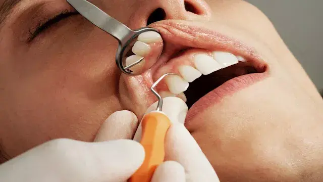 حلوى بوظيفة علاجية؟.. دراسة تكشف فوائد محتملة لصحة الفم