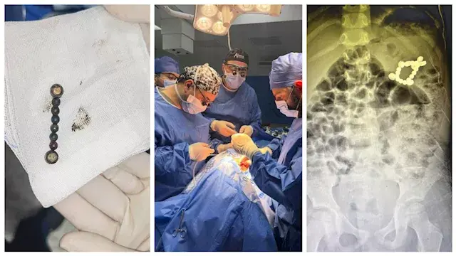 7 بطاريات و13 قطعة مغناطيسية.. إنقاذ طفل ابتلع 20 جسمًا غريبًا بالمنصورة