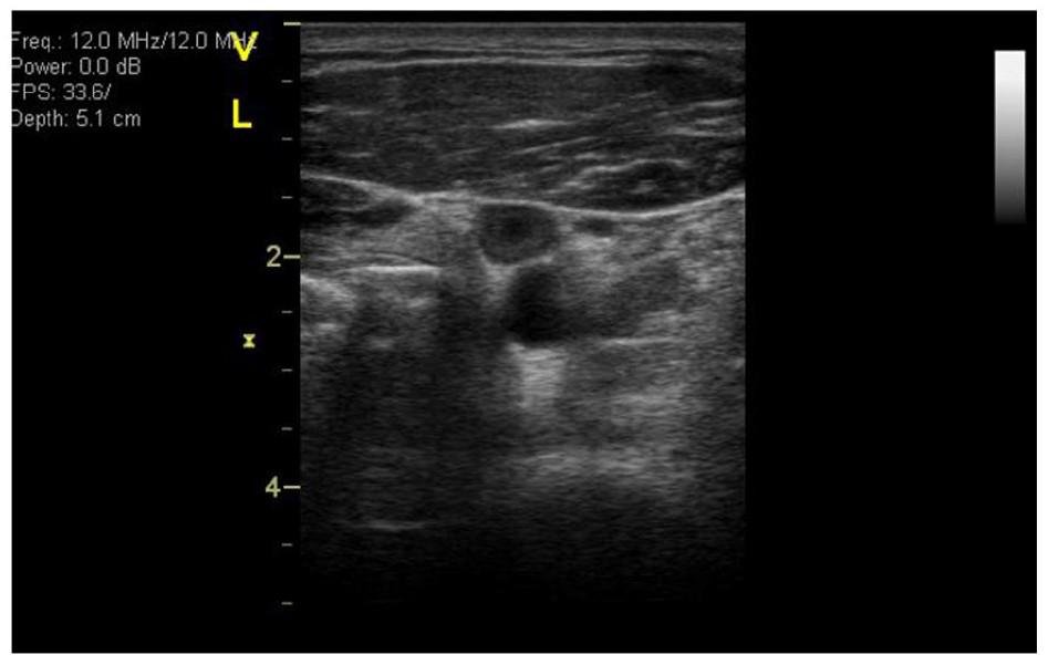 Establishing a VTE Risk Score for Astronauts Algorithm